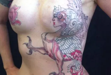 Areola de Seios de Mulheres Que Sofreram Câncer de Mama Pode Ser Redesenhada aréola